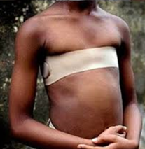 Breast ironing