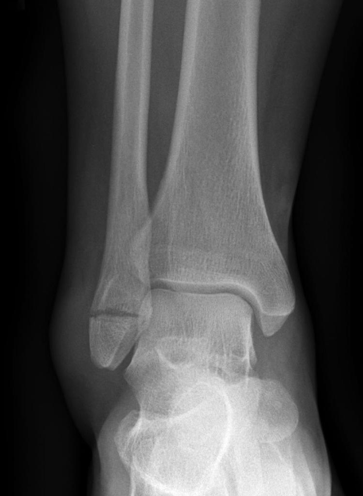 Ankle Fracture Management in Nigeria