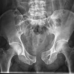 Read more about the article The Knowledge and Practice of Pelvic and Acetabular Fractures Management Among Orthopaedics and Trauma Surgeons in Nigeria