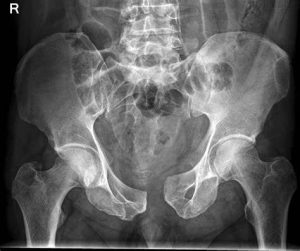 Read more about the article The Knowledge and Practice of Pelvic and Acetabular Fractures Management Among Orthopaedics and Trauma Surgeons in Nigeria